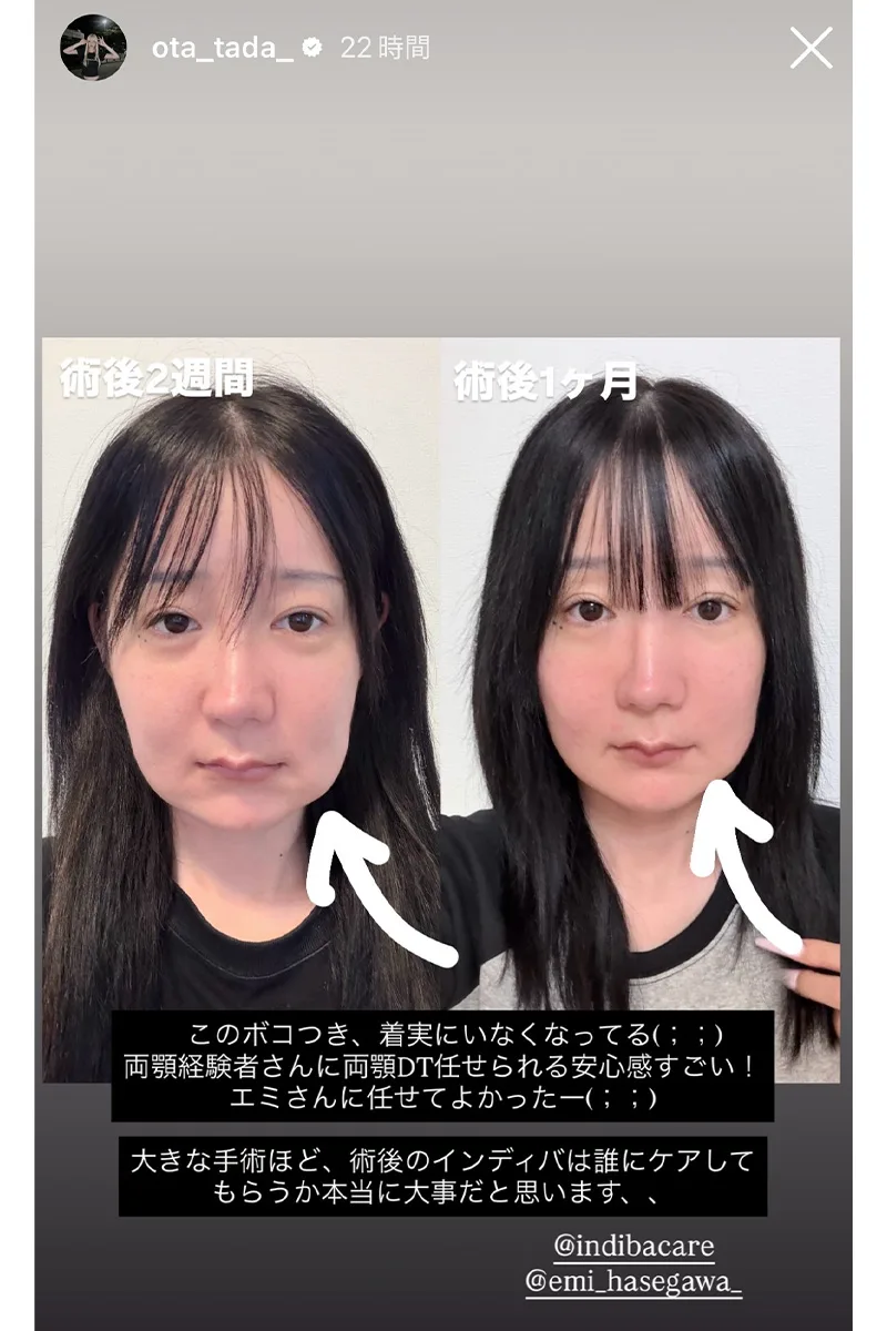 『夜ふかし』多田さん、両顎＆輪郭手術の壮絶ダウンタイムを公開「ご飯すら食べられない」